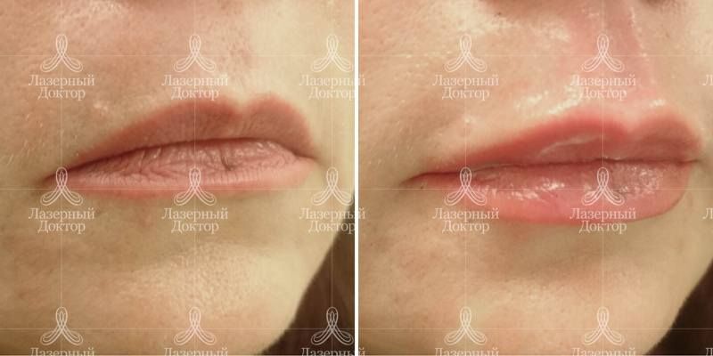 Филлеры В Эстетической Медицине Атлас Филлеры В Эстетической Медицине Атлас