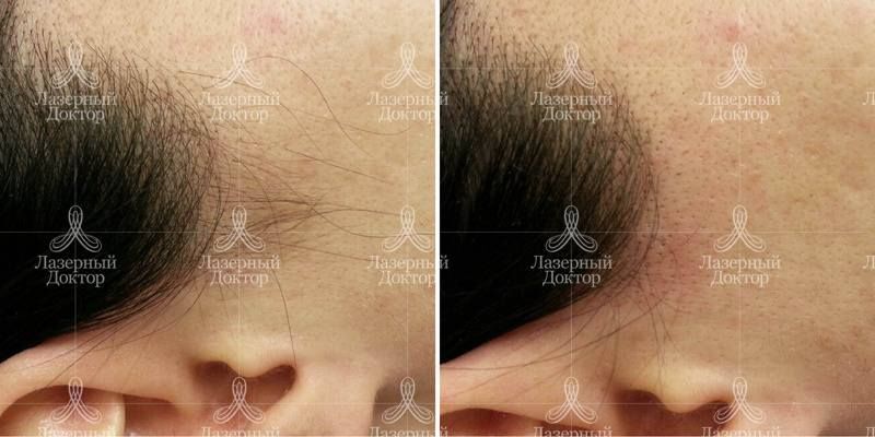 Удаление нежелательных волос на лице (фото до и после процедуры)