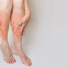 Лечение варикоза вен на ногах