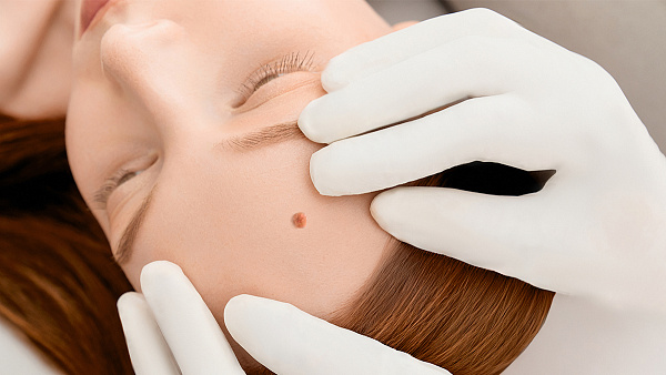 Себорейная кератома (чаще — старческие пятна на коже): почему появляется и что с ней делать