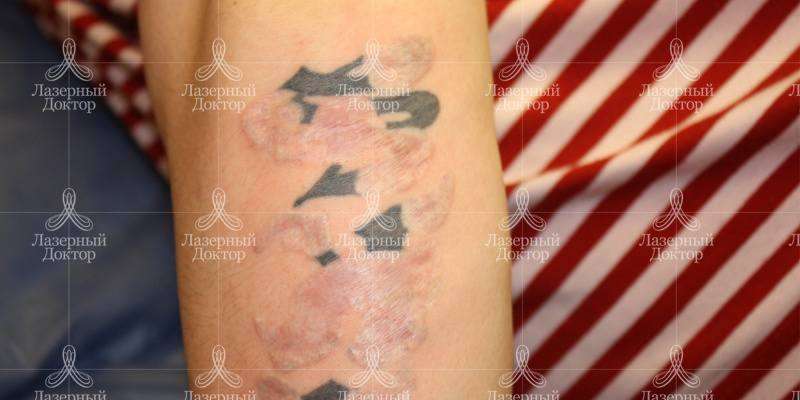 Фото результата удаления татуировки неодимовым лазером