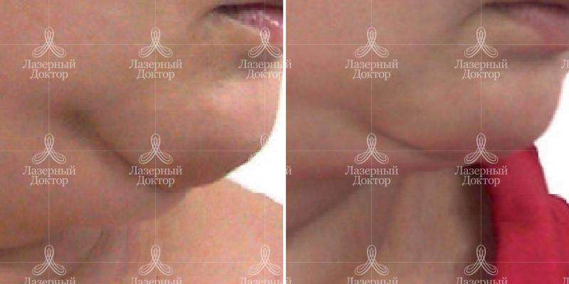 lpg массаж лица (фото до и после)