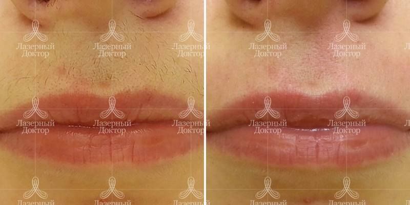 Удаление волос лазером на лице (фото до и после)