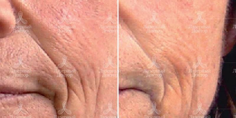 лпджи массаж лица: фото до и после