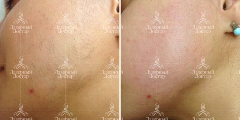 Лазерное удаление волос на лице (фото до и после)