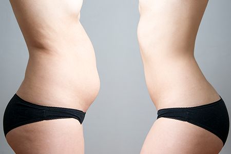 Применение «Акваликса» для безоперационной липосакции: обзор методики, принцип действия, показания и эффективность