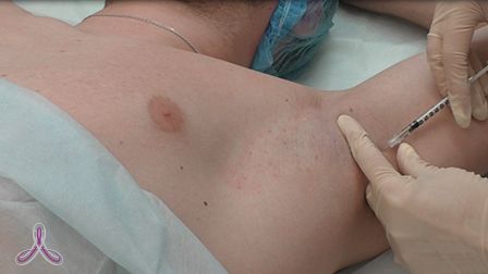 Гипергидроз: когда потливость выходит за рамки нормы