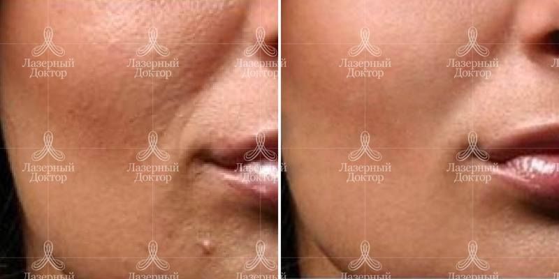 Результат от плазмолифтинга лица: фото до и после