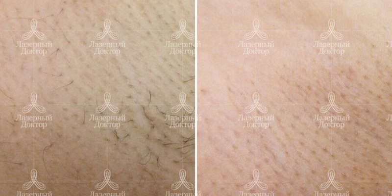 Фото до и после лазерной процедуры на нежелательных волосах подмышками