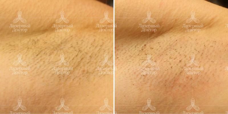 Фото до и после процедуры лазерного удаления волос в подмышечных впадинах