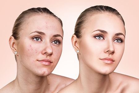 Как избавиться от постакне (следы и шрамы после прыщей)