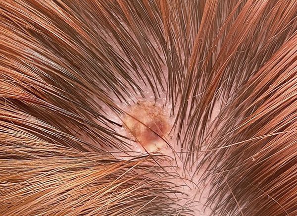 Удаление родинки на голове в волосах: вопросы и ответы