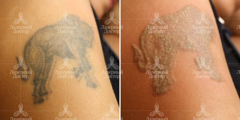 Выведение тату лазером (фото до и после)