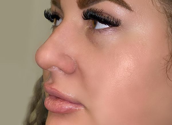 Вакуумный гидропилинг лица HydraFacial - Цены в СПб