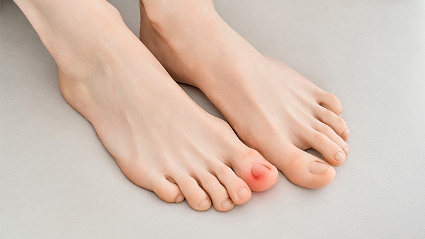 Вросший ноготь: симптомы, причины и современные методы лечения