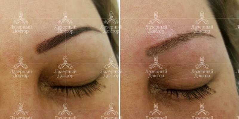 Удаление перманентного макияжа лазером: фото до и после