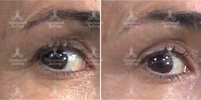 lpg лица: фото до и после