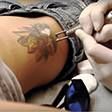 Как проходит удаление татуировок лазером