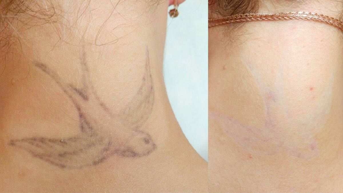 Удаление татуировок без шрамов