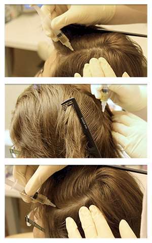 Выпадение волос - причины и лечение у женщин