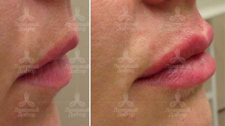 увеличения губ гиалуроновой кислотой
