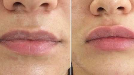 Как увеличить губы: все, что нужно знать
