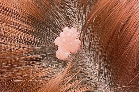 Атерома волосистой части головы