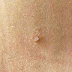 Лечение фибромы кожи - удаление лазером на теле