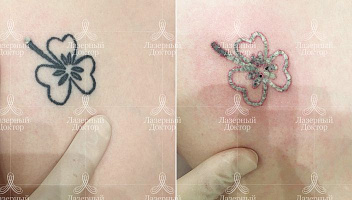 удаление татуировки до и после