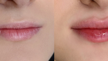 Контурная пластика губ Juvederm 