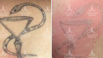 Лазерное удаление татуировки на плече