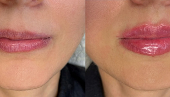 Контурная пластика губ Juvederm 