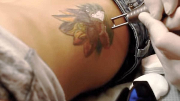 Удаление цветных татуировок на теле лазером SPECTRA